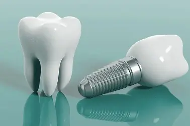 Implant Treatment - Malatya Diş