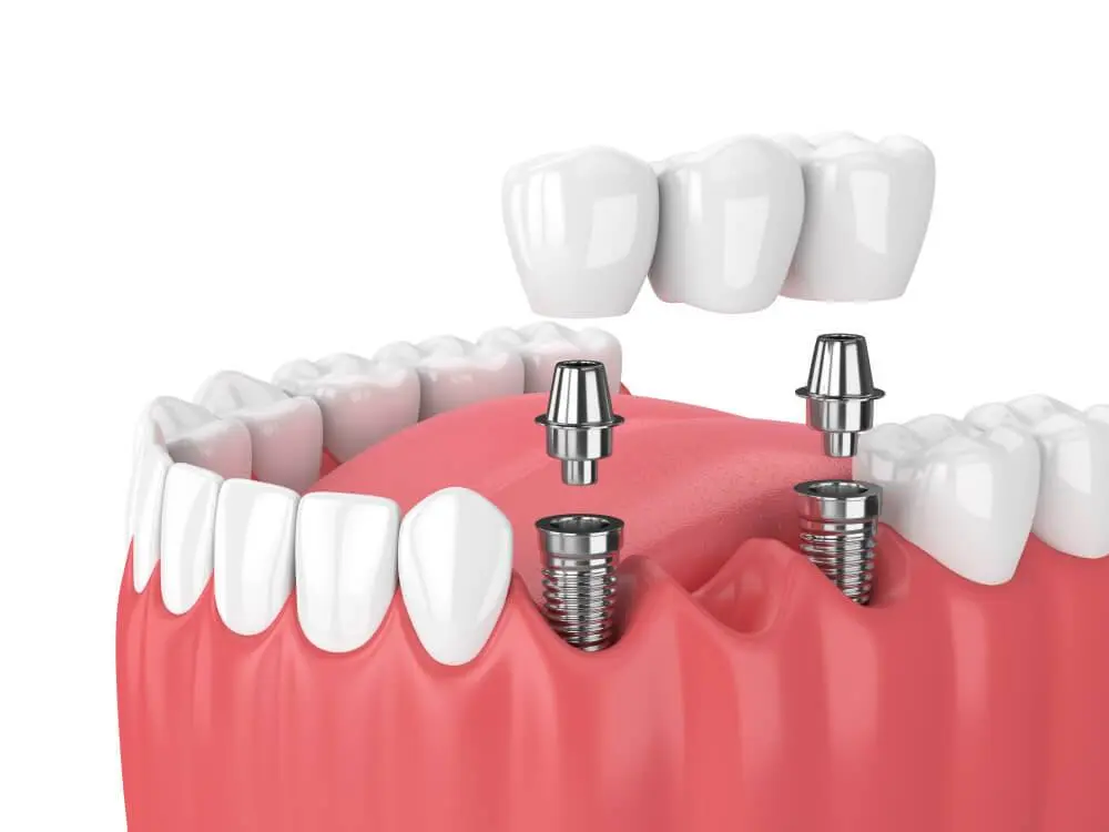 Prosthetic Dentistry Malatya